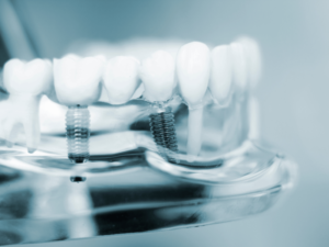 Implantes dentários.